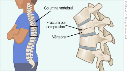 ¿Cómo se trata la fisura vertebral?