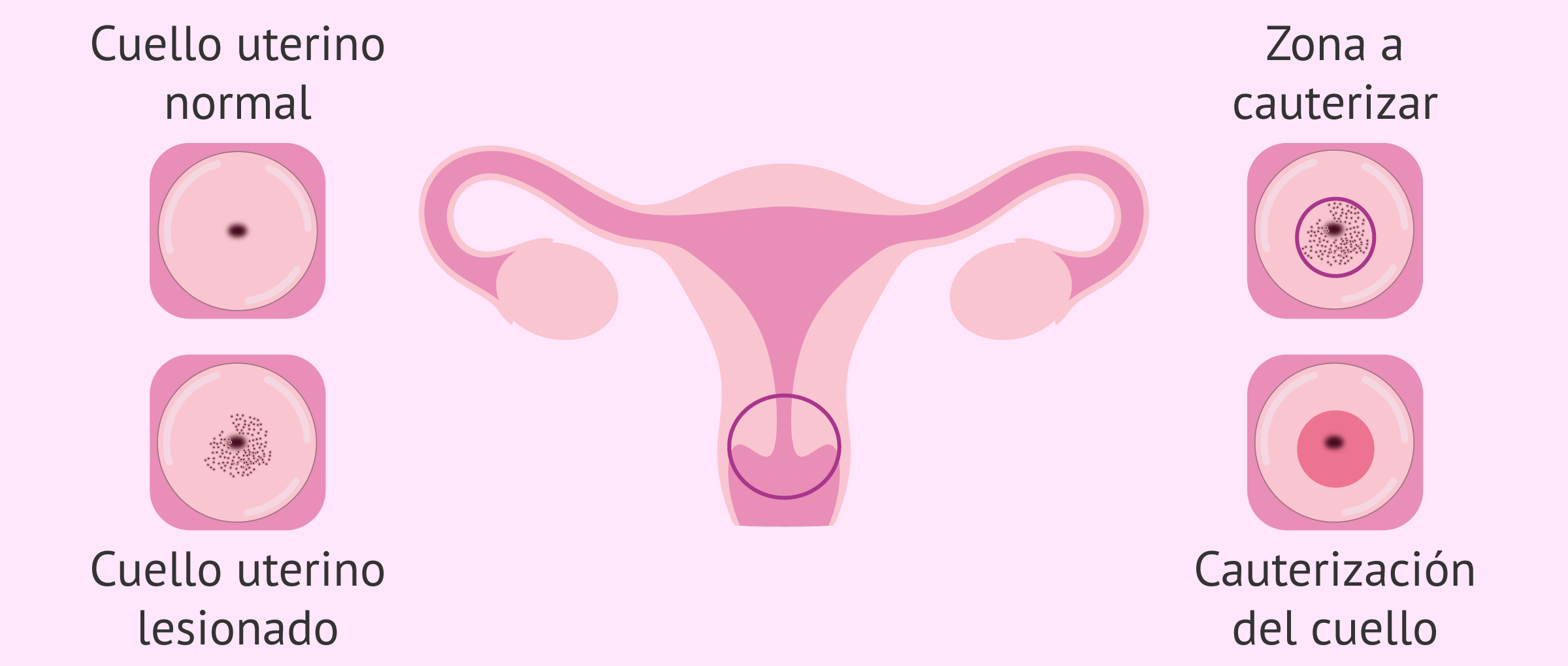 ¿Qué es la cauterización cervical?