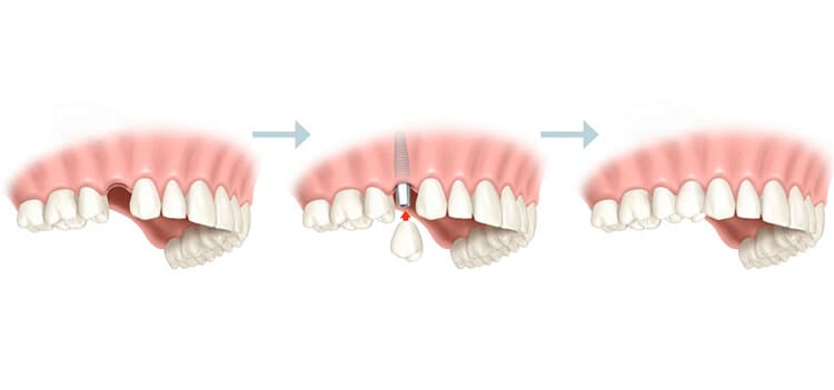 ¿Tiempo entre la extracción del diente y el implante?