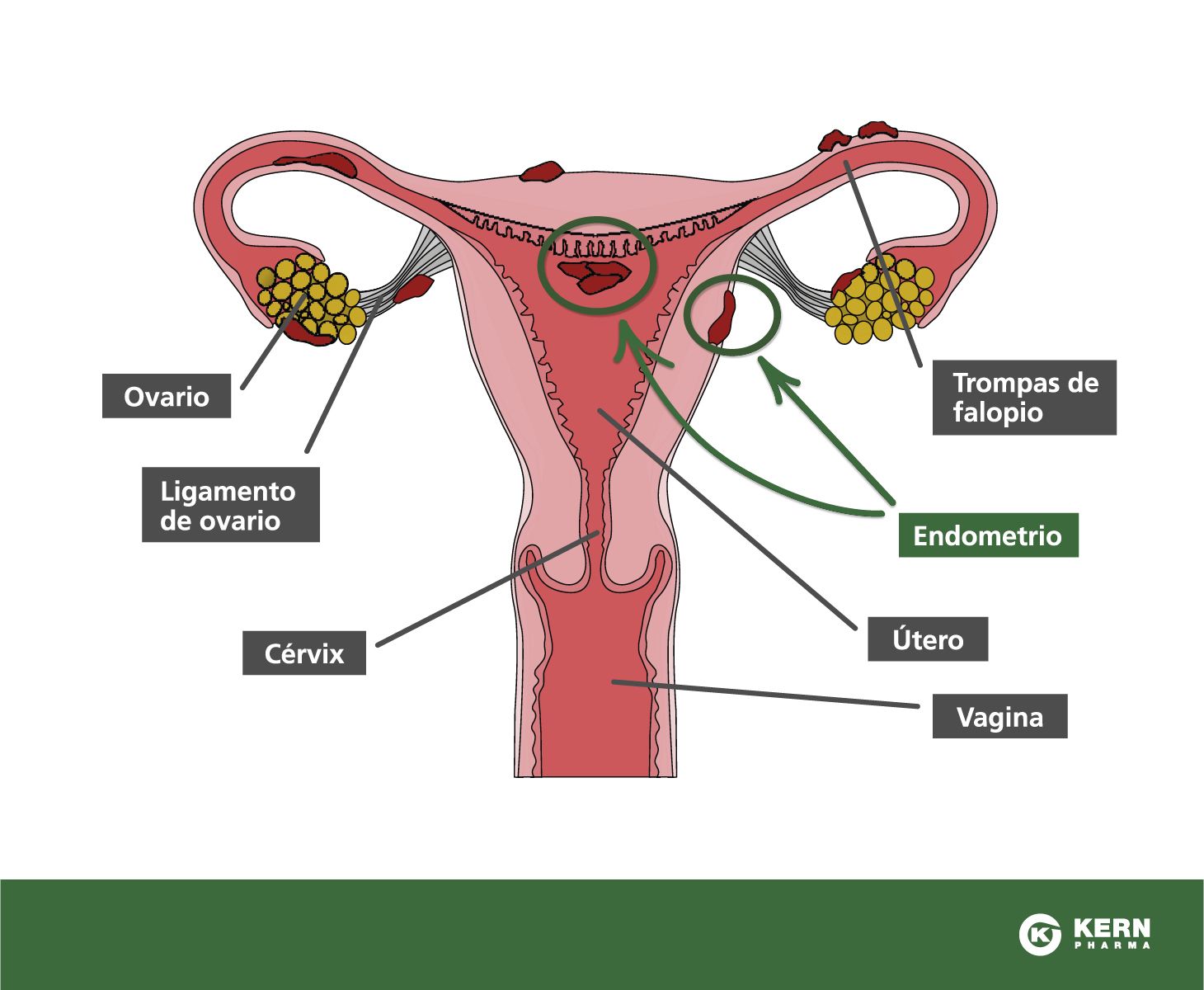 ¿Cómo se desprende el endometrio?