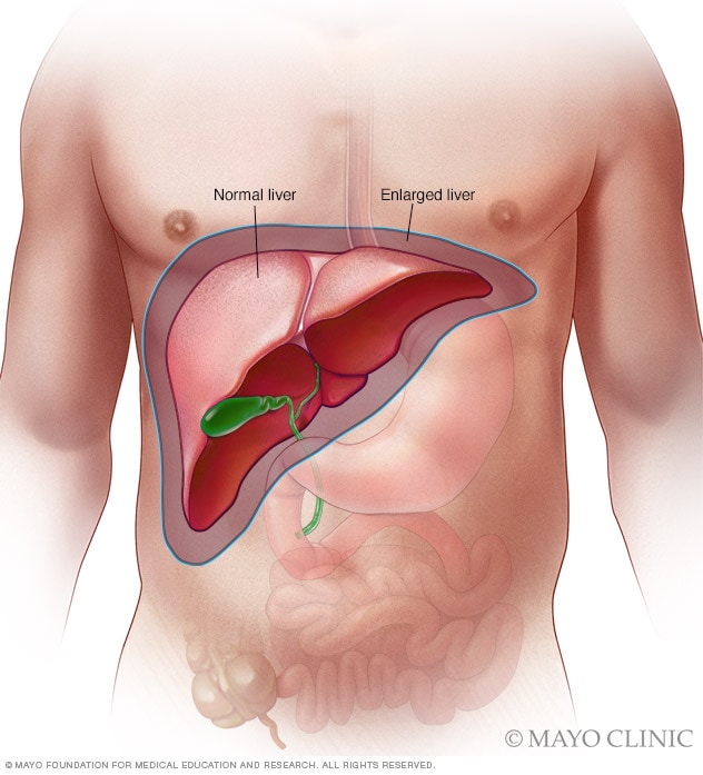 ¿Qué significa hígado desbordado?